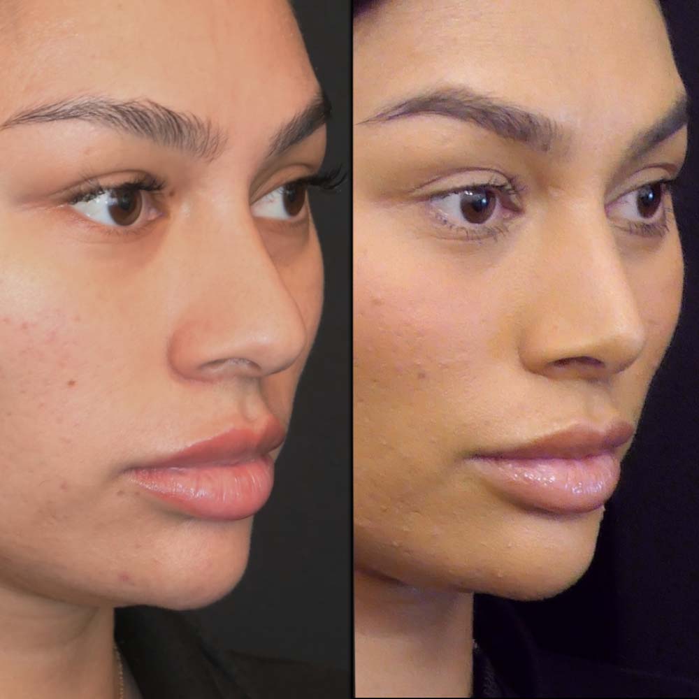 Rhinoplasty-1