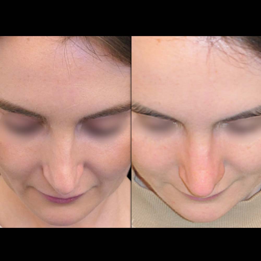 rhinoplasty-N1